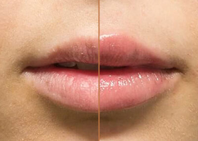 Lip Augmentation before and after photos by Sherber and Rad in Washington, DC