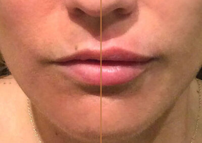 Lip Augmentation before and after photos by Sherber and Rad in Washington, DC