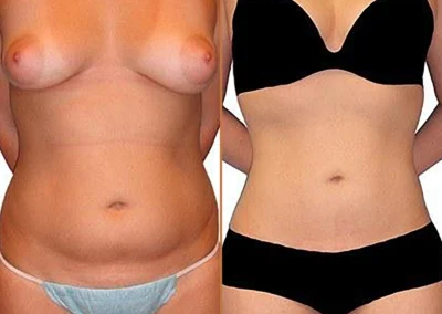 Tummy Tuck Liposuction before and after photos by Sherber and Rad in Washington, DC