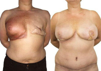 DIEP Flap before and after photos by Sherber and Rad in Washington, DC