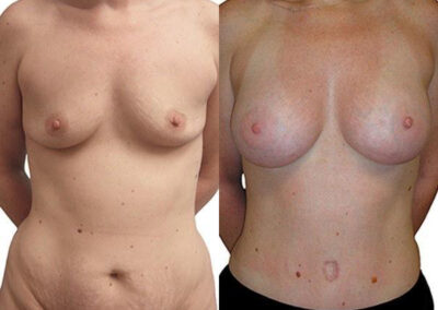 Mommy Makeover before and after photos by Sherber and Rad in Washington, DC