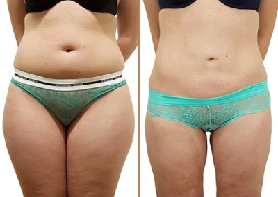 Tummy Tuck Liposuction before and after photos by Sherber and Rad in Washington, DC