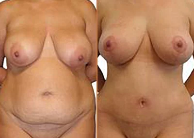 Tummy Tuck Liposuction before and after photos by Sherber and Rad in Washington, DC
