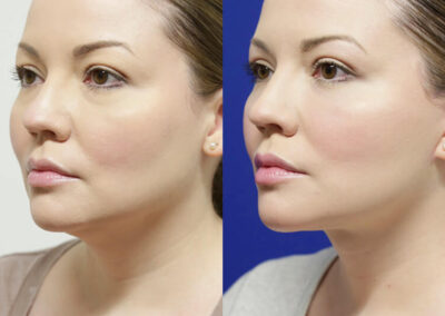 Neck Lift before and after photos by Sherber and Rad in Washington, DC