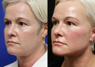 Neck Lift before and after photos by Sherber and Rad in Washington, DC