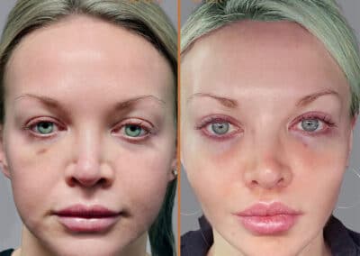 Deep Plane Facelift before and after photos by Sherber and Rad in Washington