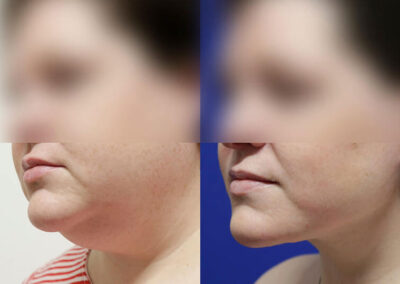 Neck Lift before and after photos by Sherber and Rad in Washington, DC