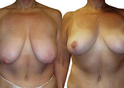 Breast Lift + Reduction before and after photos by Sherber and Rad in Washington, DC
