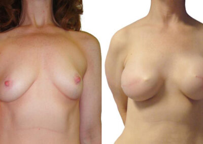 Implants before and after photos by Sherber and Rad in Washington, DC