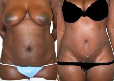 Tummy Tuck + Liposuction before and after photos by Sherber and Rad in Washington, DC