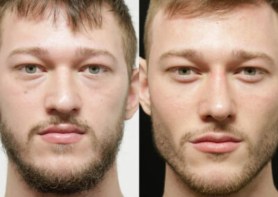 Buccal Fat Removal before and after photos by Sherber and Rad in Washington, DC