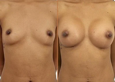 Breast Augmentation before and after photos by Sherber and Rad in Washington, DC