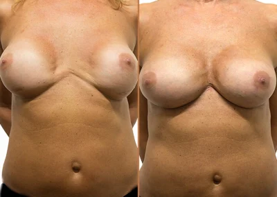 Breast Augmentation before and after photos by Sherber and Rad in Washington, DC