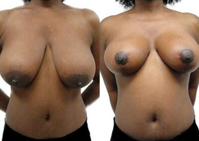 Breast Lift + Reduction before and after photos by Sherber and Rad in Washington, DC