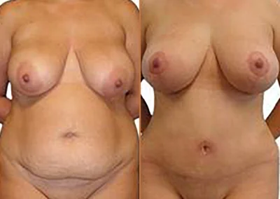 Breast Lift Reduction before and after photos by Sherber and Rad in Washington, DC