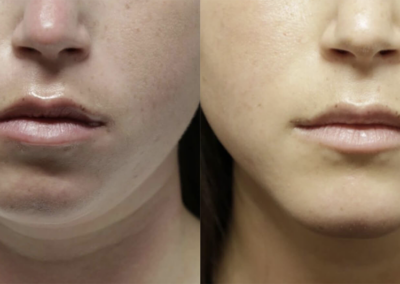Chin + Jaw Reshaping before and after photos by Sherber and Rad in Washington, DC