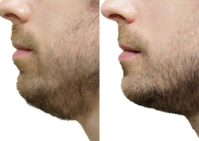Male Facelift before and after photos by Sherber and Rad in Washington, DC