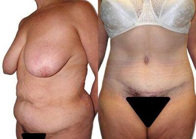 Tummy Tuck + Liposuction before and after photos by Sherber and Rad in Washington, DC
