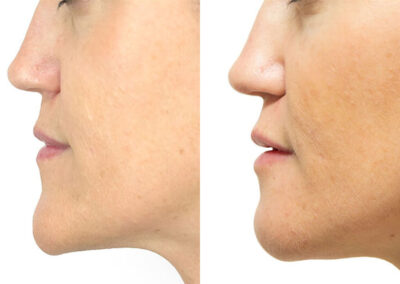Chin + Jaw Reshaping before and after photos by Sherber and Rad in Washington, DC