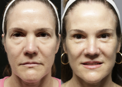 Facial Fat Transfer before and after photos by Sherber and Rad in Washington, DC
