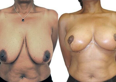 Breast Lift + Reduction before and after photos by Sherber and Rad in Washington, DC