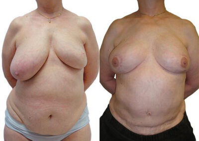 DIEP Flap before and after photos by Sherber and Rad in Washington, DC