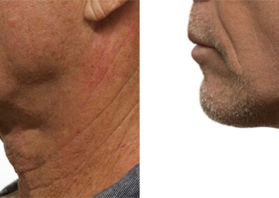 Male Facelift before and after photos by Sherber and Rad in Washington, DC