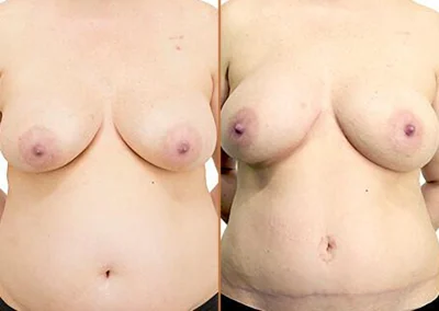 Diep Flap before and after photos by Sherber and Rad in Washington, DC