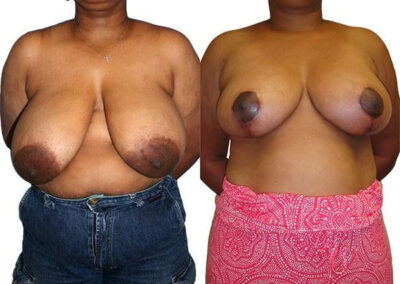Breast Lift + Reduction before and after photos by Sherber and Rad in Washington, DC