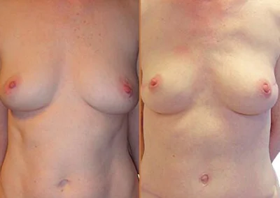Diep Flap before and after photos by Sherber and Rad in Washington, DC