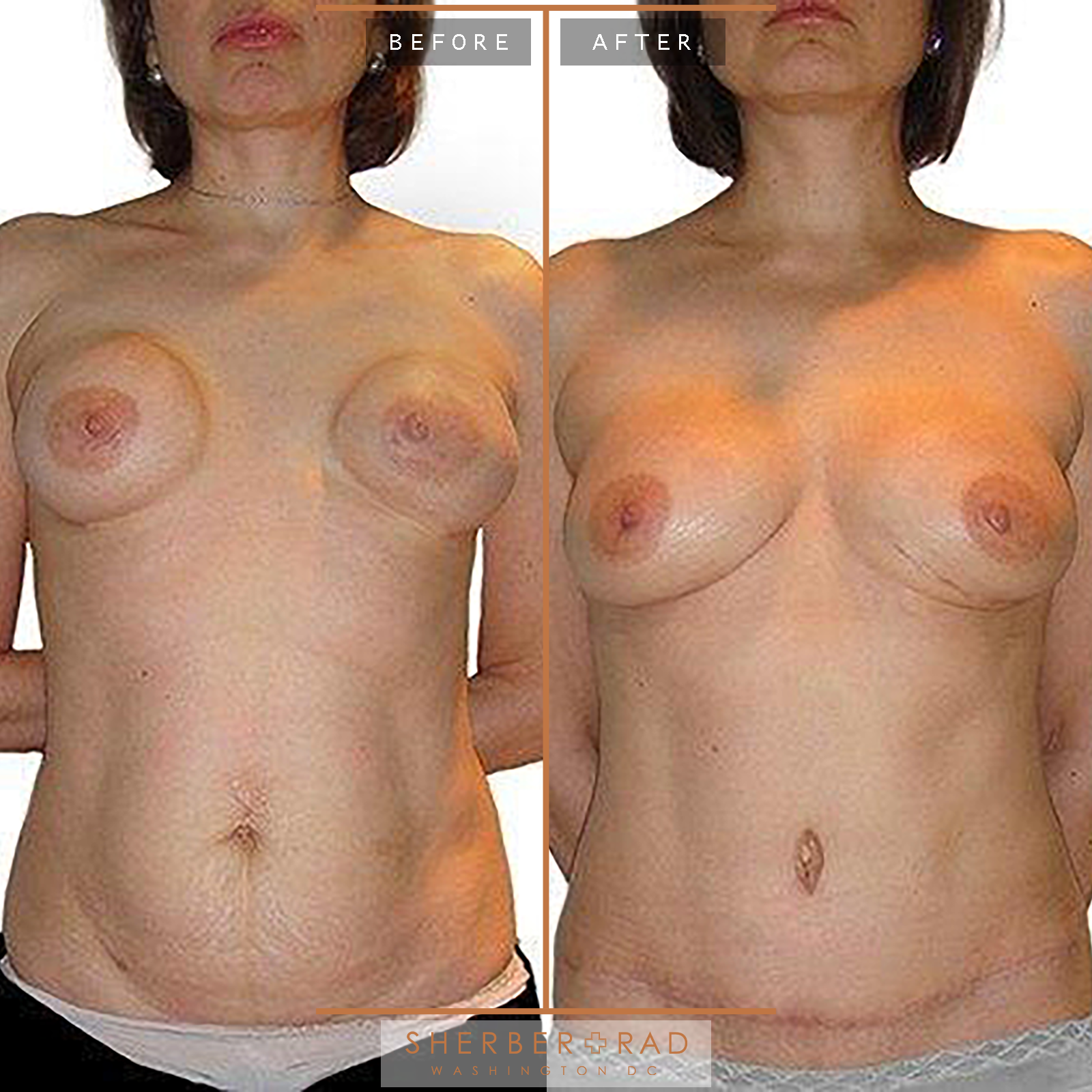 Diep Flap before and after photos by Sherber and Rad in Washington, DC