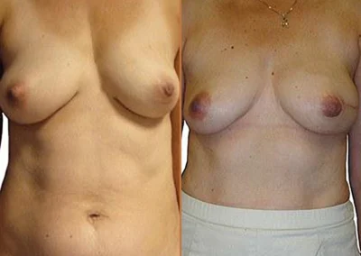 Diep Flap before and after photos by Sherber and Rad in Washington, DC
