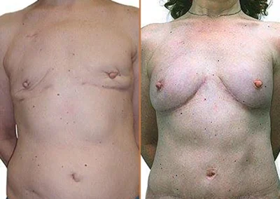 Diep Flap before and after photos by Sherber and Rad in Washington, DC