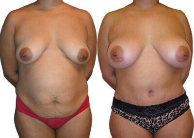Tummy Tuck + Liposuction before and after photos by Sherber and Rad in Washington, DC
