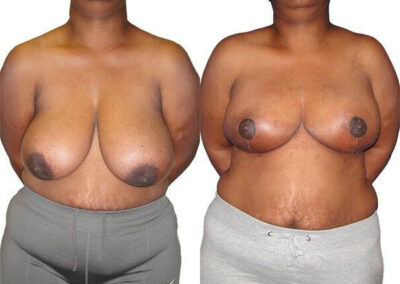 Breast Lift + Reduction before and after photos by Sherber and Rad in Washington, DC