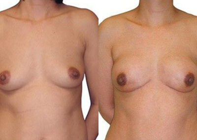 DIEP Flap before and after photos by Sherber and Rad in Washington, DC