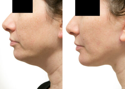 Chin + Jaw Reshaping before and after photos by Sherber and Rad in Washington, DC