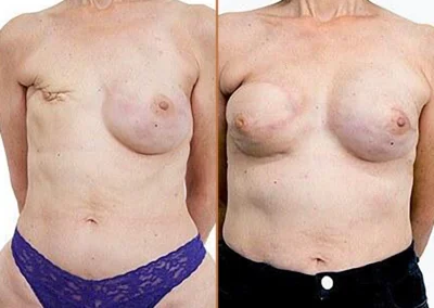 Love Handle Flap before and after photos by Sherber and Rad in Washington, DC