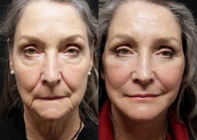 Facial Fat Transfer before and after photos by Sherber and Rad in Washington, DC