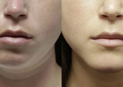 chin jaw reshaping before and after