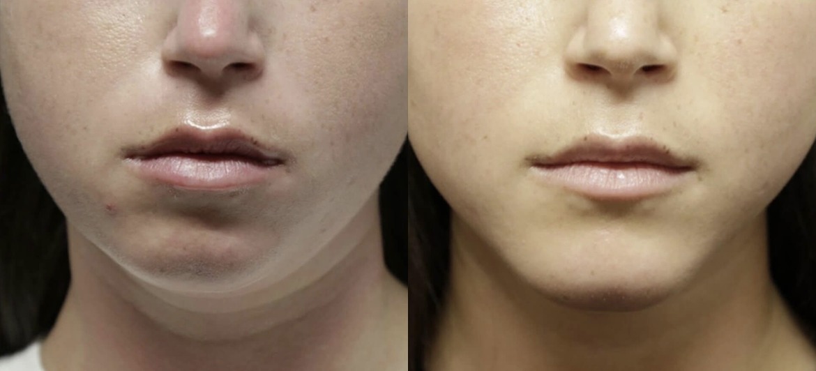 chin jaw reshaping before and after