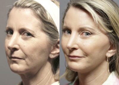 fat grafting before and after