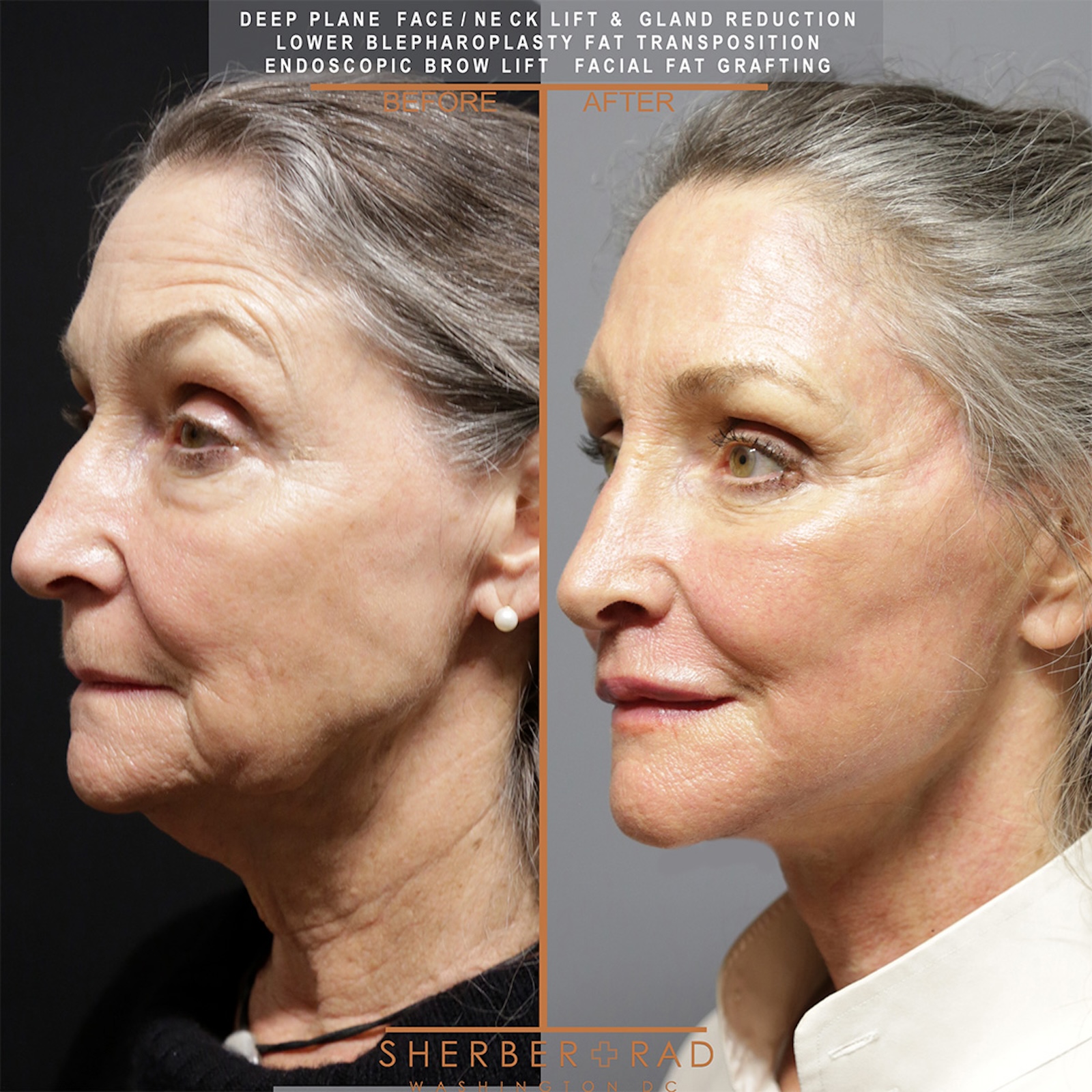 . facelift before and after results