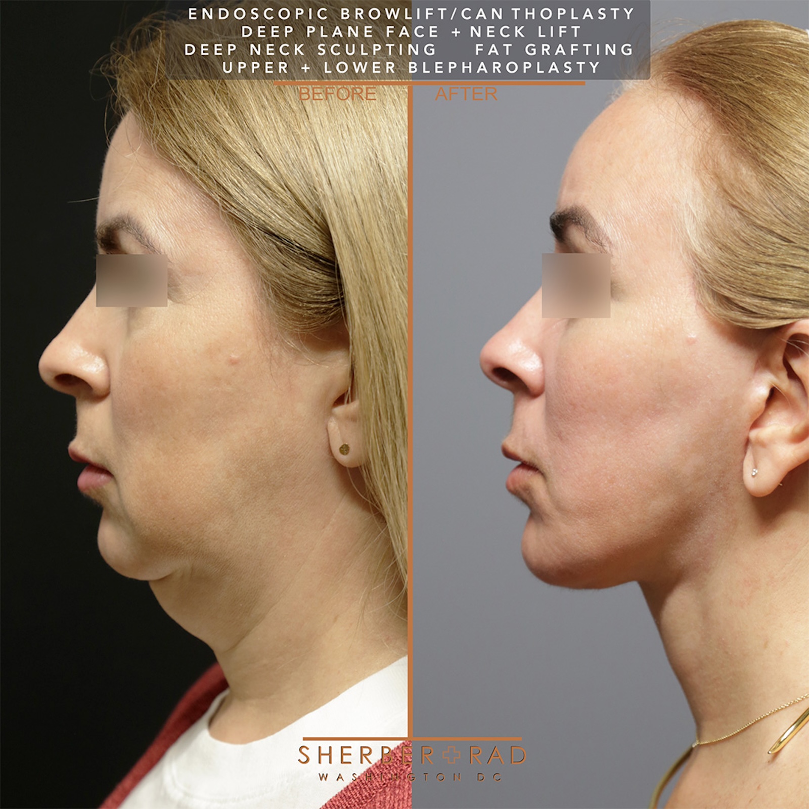 . neck lift before and after results