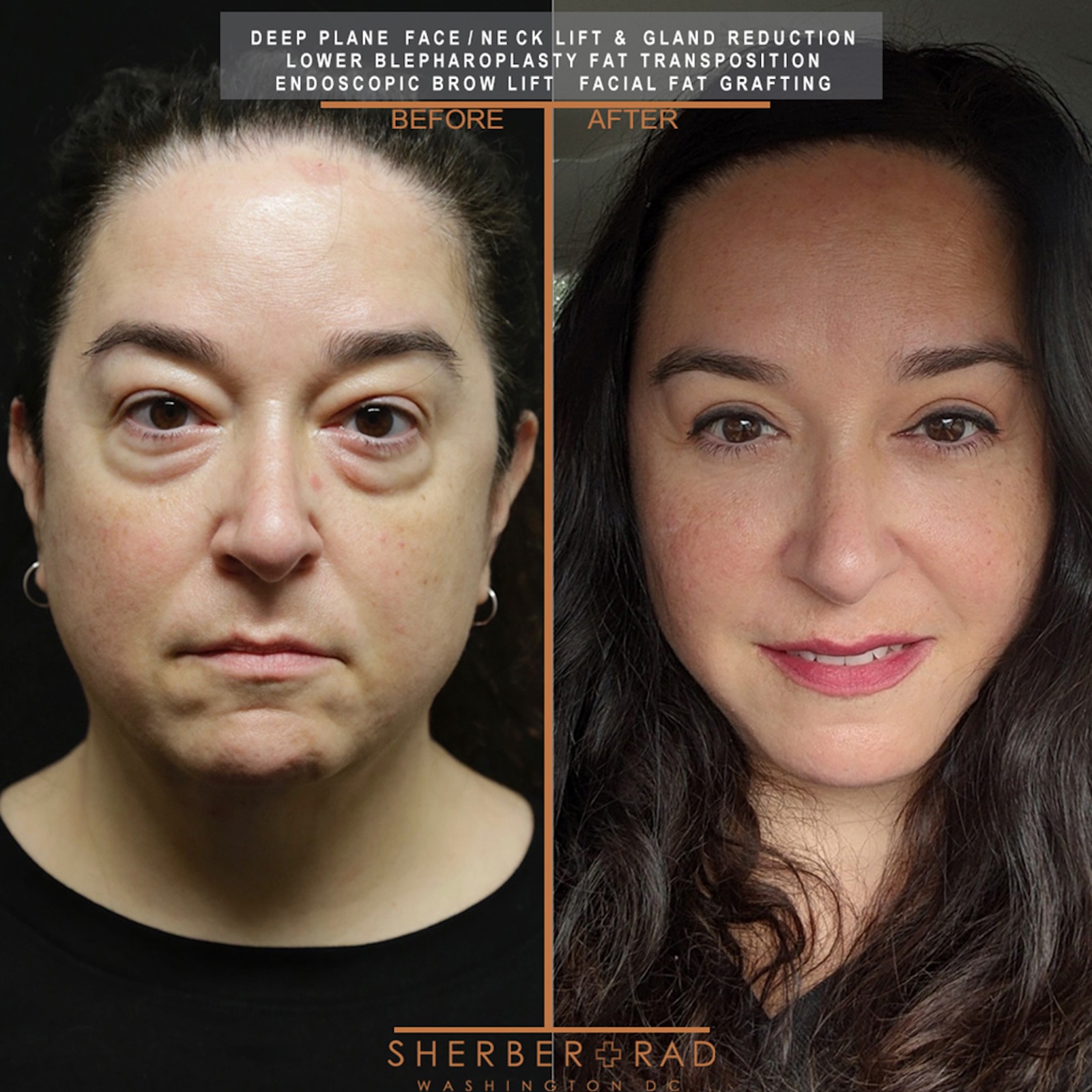. eyes before and after results