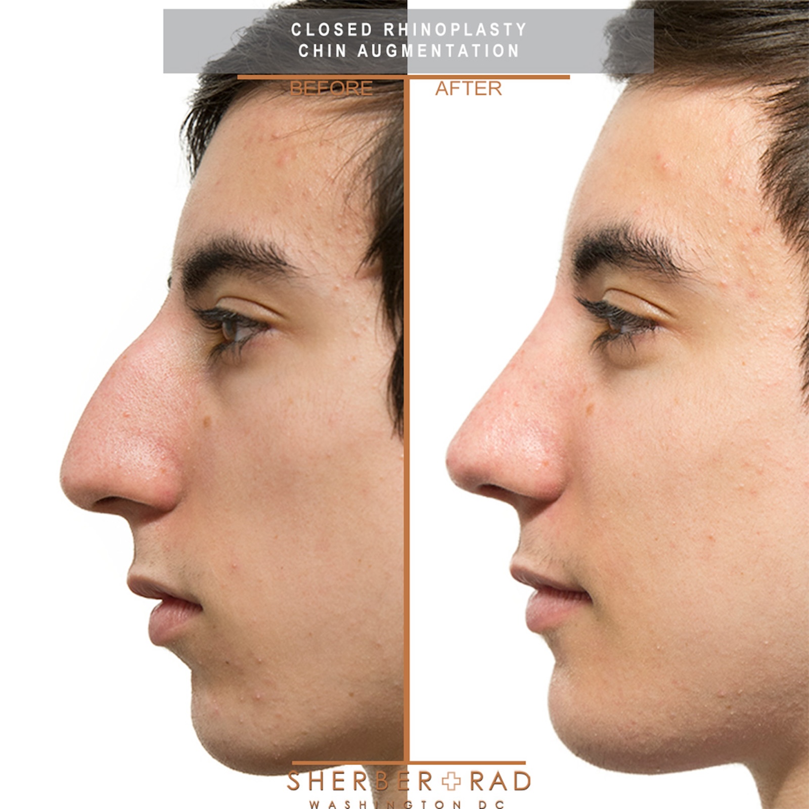 . chin + jaw before and after results