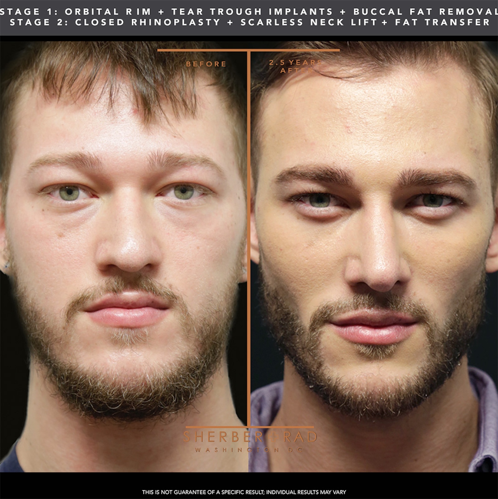 . facial optimization before and after results