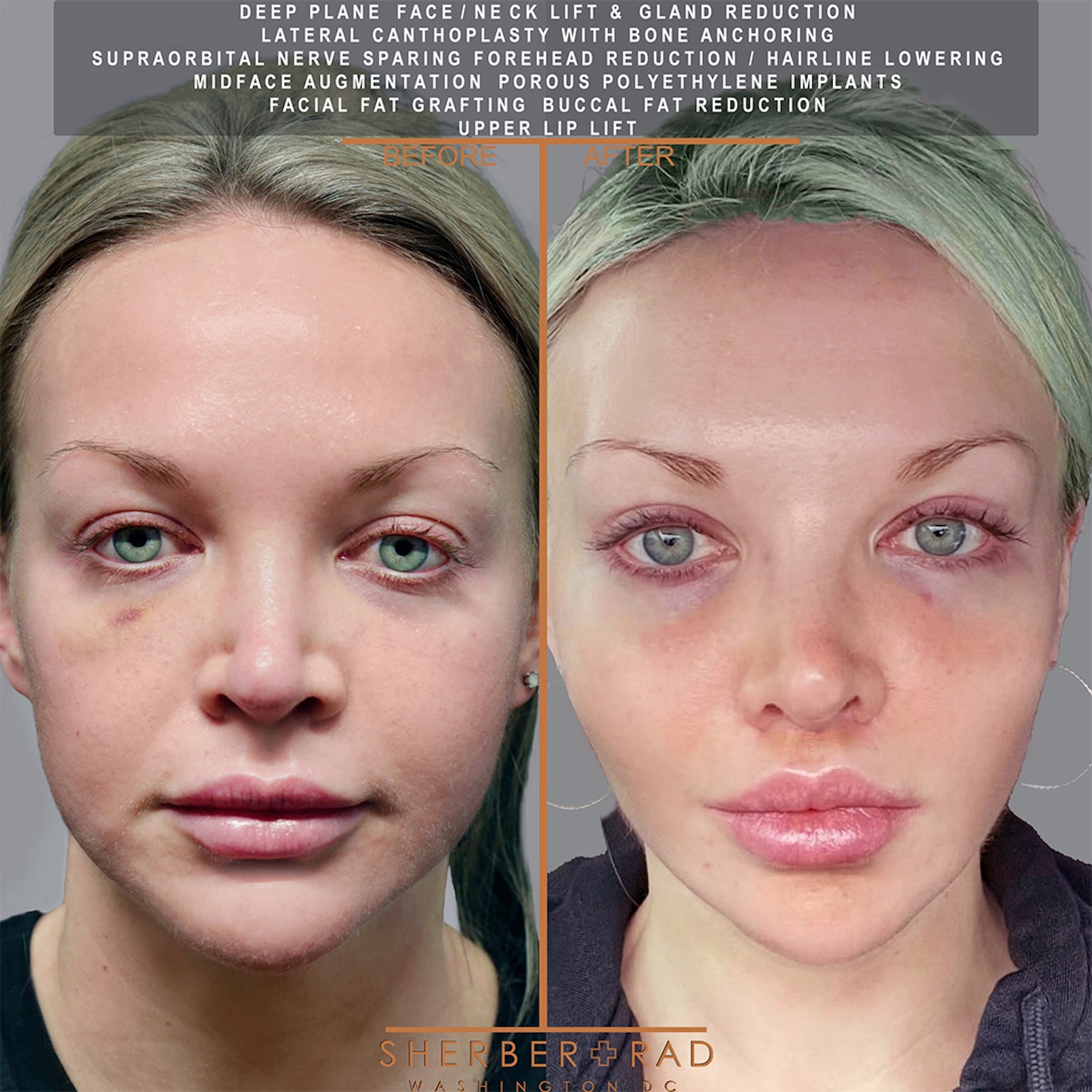 . other facial procedures before and after results