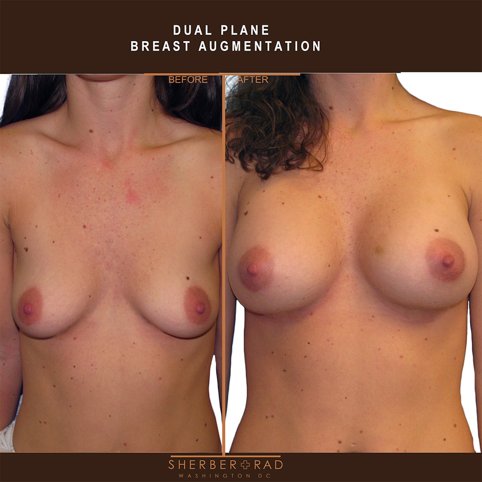 . breast + body before and after results