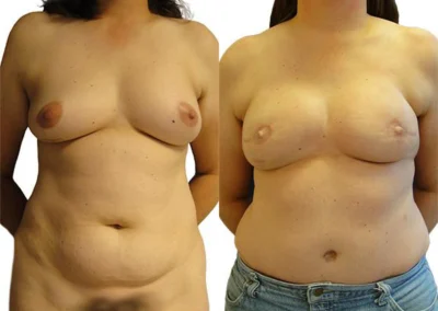 Breast Reconstruction before and after photos by Sherber and Rad in Washington, DC